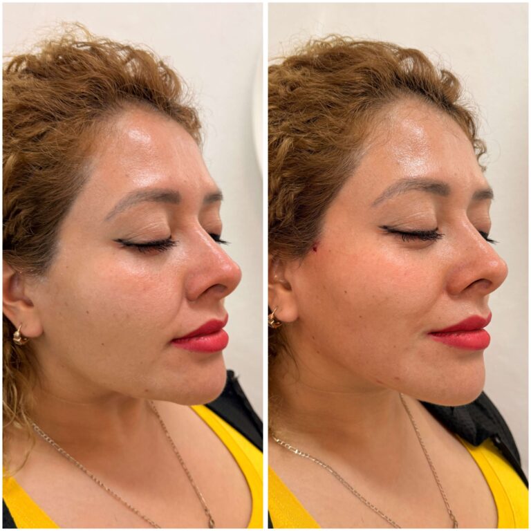 Antes y después de hilos tensores en CDMX con mayor definición facial