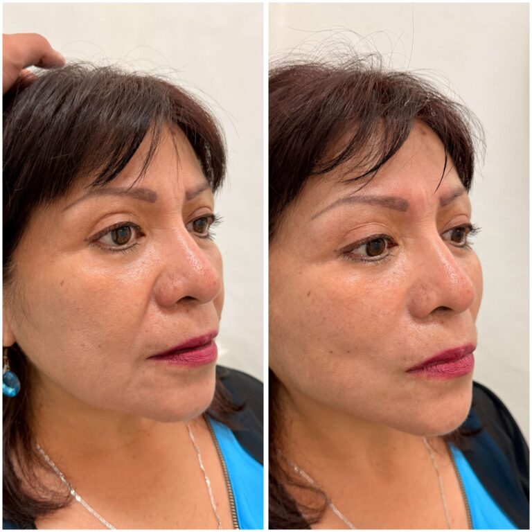 Antes y después de un tratamiento con hilos tensores en Eternal Glow, CDMX