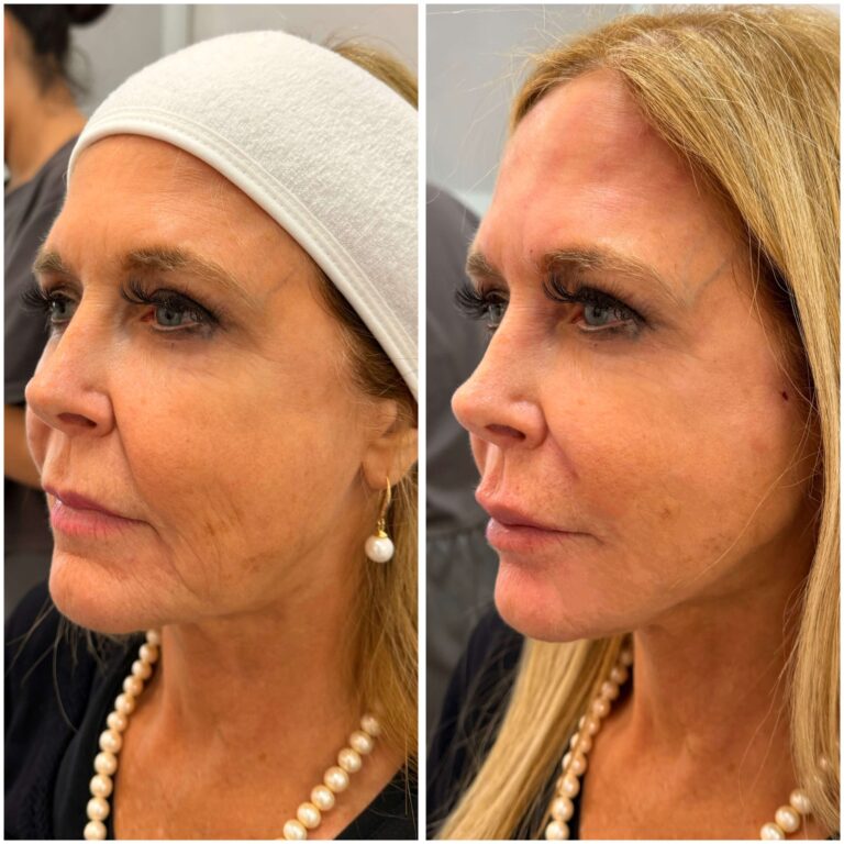 Antes y después de hilos tensores para rejuvenecimiento facial en CDMX