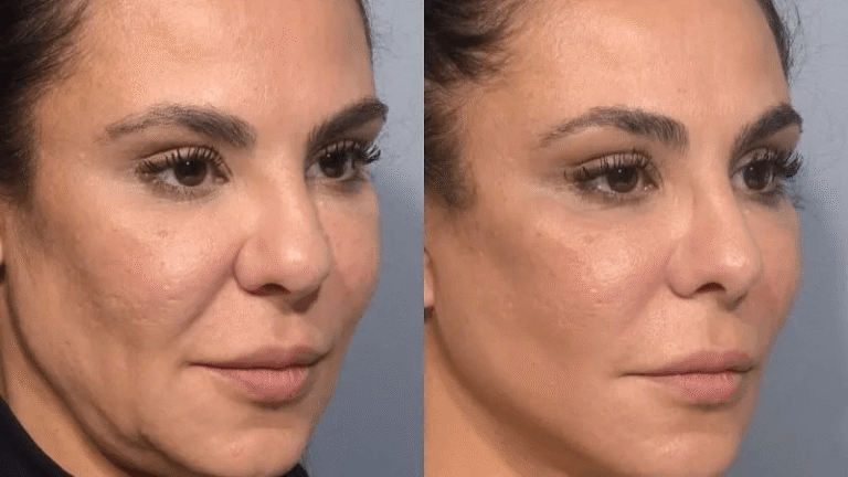 Antes y después de Sculptra en la cara, Eternal Glow CDMX
