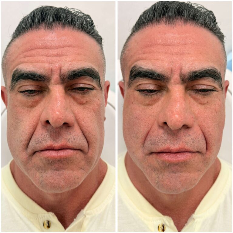 Antes y después de un tratamiento con Sculptra en un hombre, CDMX