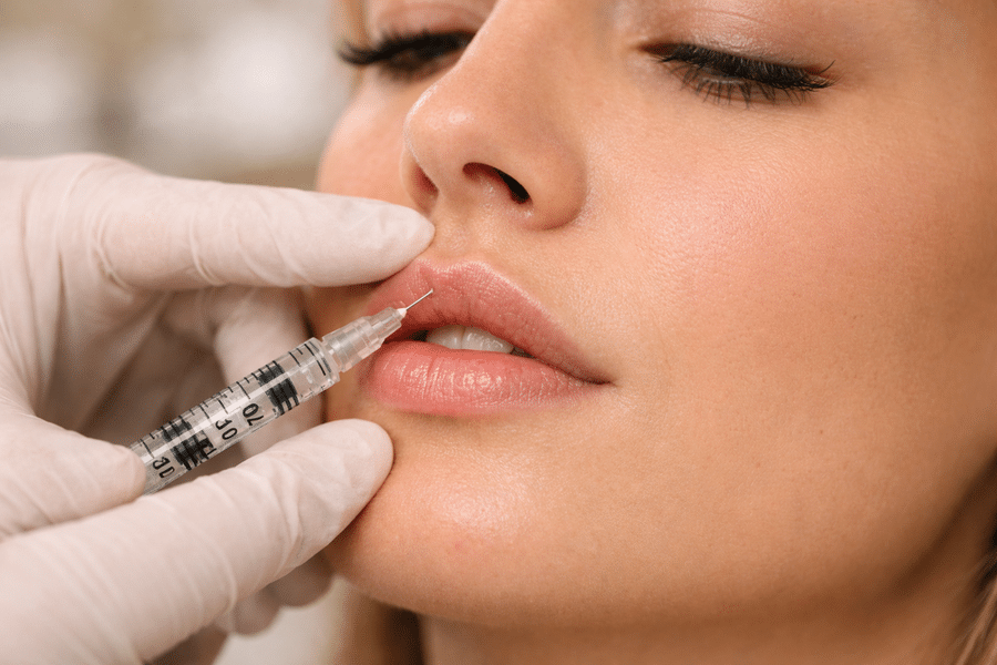 Inyección de botox en labio superior para lograr efecto lip flip natural.
