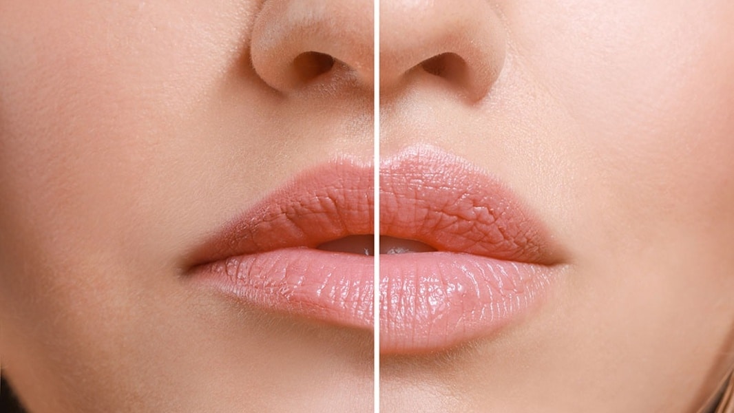 Imagen ilustrativa de labios antes y después de un relleno con ácido hialurónico